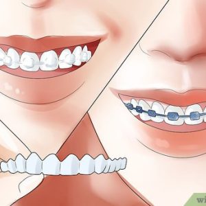 Uncover the Secrets: Discover How to Know if Braces Are Right for You 16 uncover the secrets discover how to know if braces are right for you