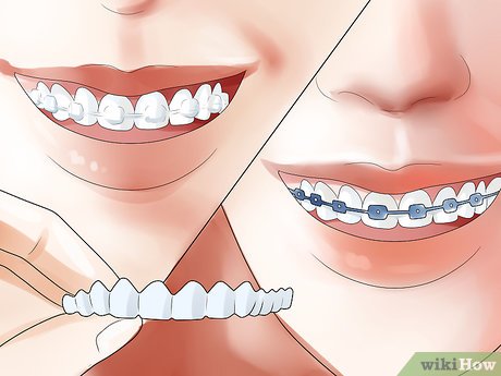 Uncover the Secrets: Discover How to Know if Braces Are Right for You 1 uncover the secrets discover how to know if braces are right for you