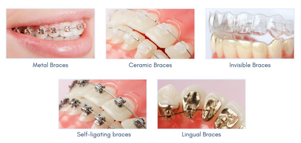 Unveiling the Signs: Discover if Braces Are Right for You 1 unveiling the signs discover if braces are right for you