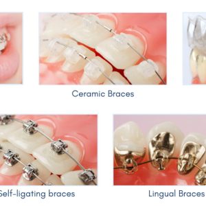 Unveiling the Signs: Discover if Braces Are Right for You 22 unveiling the signs discover if braces are right for you