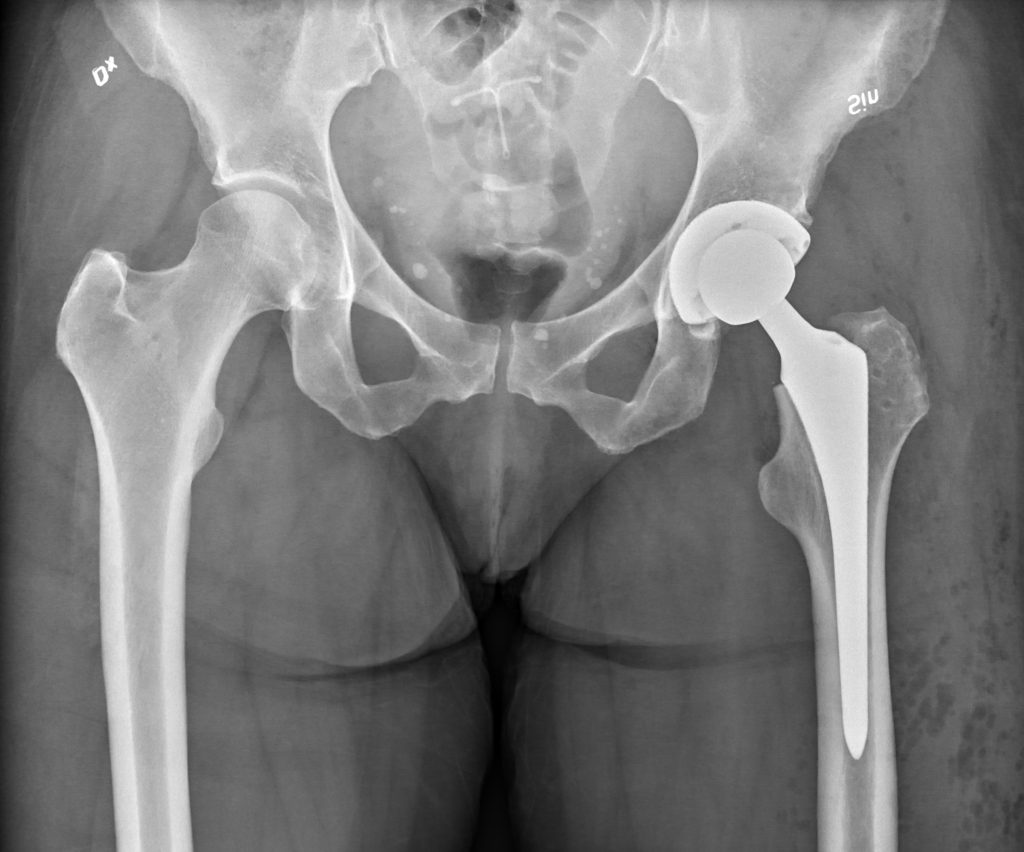 X-Ray Insights: Uncover the Need for Hip Replacement 1 x ray insights uncover the need for hip replacement