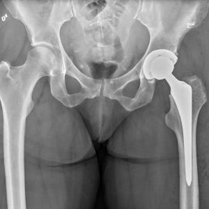 X-Ray Insights: Uncover the Need for Hip Replacement 13 x ray insights uncover the need for hip replacement